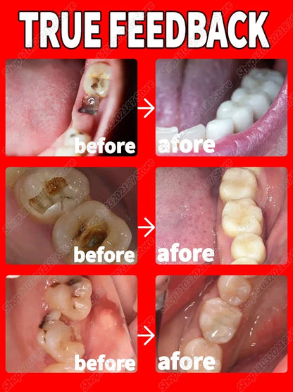 anti-cavity tooth decay Teeth whitening