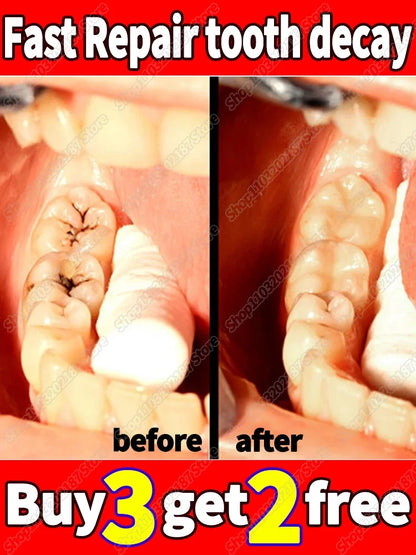 anti-cavity tooth decay Teeth whitening